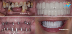Cấy ghép implant cho người mất hết toàn bộ răng - Nha khoa Lạc Việt