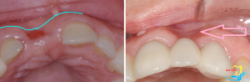 Cấy ghép implant tức thì ngay sau khi nhổ răng - Nha khoa Lạc Việt