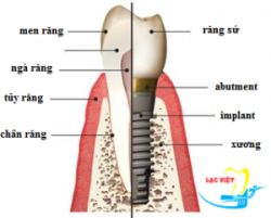 Cách trồng răng implant - Nha khoa Lạc Việt