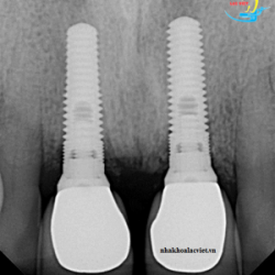 Cấy ghép implant cho trường hợp mất nhiều răng - Nha khoa Lạc Việt