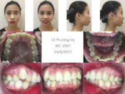 Lột xác sau 12 tháng niềng răng hô & khấp khểnh - Bác sĩ Việt Anh