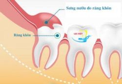 Không nhổ răng khôn mọc lệch liệu có ảnh hưởng tới sức khỏe không? - Nha khoa Lạc Việt