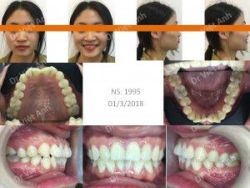Một ca niềng sắp đều răng đơn giản trong 10 tháng - Bác sĩ Việt Anh