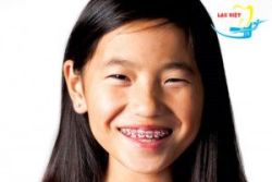 Niềng răng cho trẻ em giá bao nhiêu và phương pháp tiết kiệm nhất - Nha khoa Lạc Việt