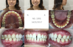 Niềng răng thưa thay đổi hoàn toàn diện mạo khuôn mặt - Bác sĩ Việt Anh