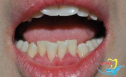 Nắn chỉnh răng – Giải pháp tối ưu cho hàm răng khấp khểnh - Nha khoa Lạc Việt