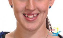 So sánh niềng răng với bọc răng sứ thẩm mỹ cho răng khấp khểnh - Nha khoa Lạc Việt