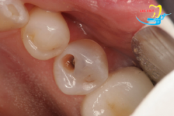 Răng vĩnh viễn bị sâu phải xử lý như thế nào? - Nha khoa Lạc Việt