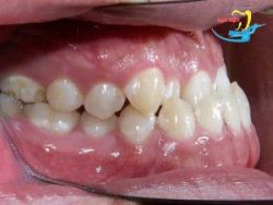 Niềng răng móm bao lâu đạt kết quả và phương pháp nhanh nhất - Nha khoa Lạc Việt