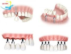 Cắm ghép implant – Phương pháp trồng răng bền đẹp an toàn và hiệu quả. - Nha khoa Lạc Việt