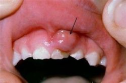 Chân răng có mủ là bệnh lý gì ? - Nha khoa Đăng Lưu