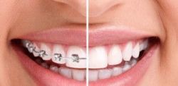 Tổng hợp lợi ích từ việc niềng răng chỉnh nha - Nha khoa Đăng Lưu