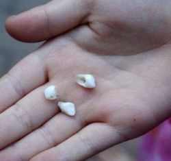 Mất răng có nguy cơ ung thư tăng cao - Nha khoa Đăng Lưu