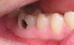Diễn biến của bệnh viêm tủy răng - Nha khoa Đăng Lưu