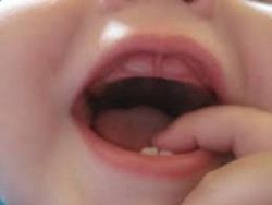 Tác hại của răng cửa mọc chậm - Nha khoa Đăng Lưu