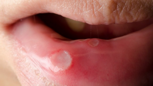 Nguyên nhân gây loét miệng ở người nhiễm HIV