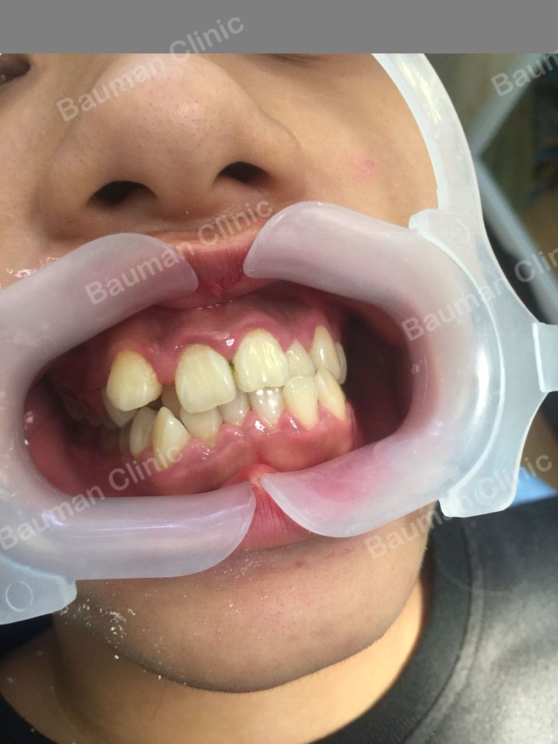 Ca niềng răng số 5067 - Nha khoa Bauman Clinic