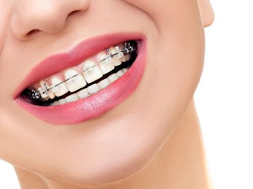 Có nên niềng răng không thưa bác sĩ? Chuyên gia nha khoa Paris giải đáp
