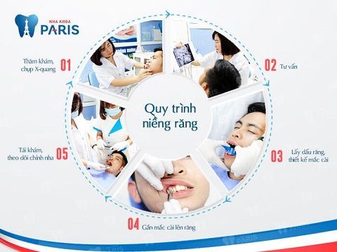 Quy trình niềng răng thẩm mỹ ” Tiết Kiệm” THỜI GIAN hiệu quả - nha khoa Paris