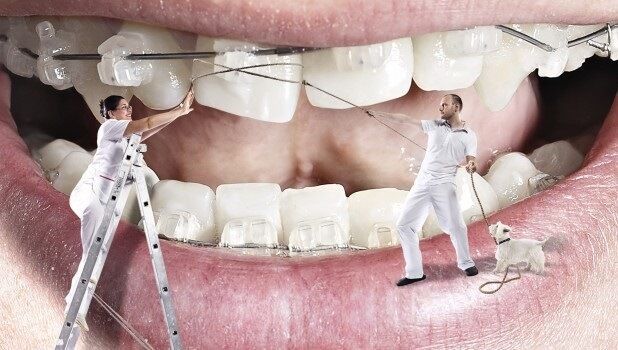 Niềng răng là gì? 5 yếu tố không thể bỏ qua khi niềng răng - nha khoa Paris