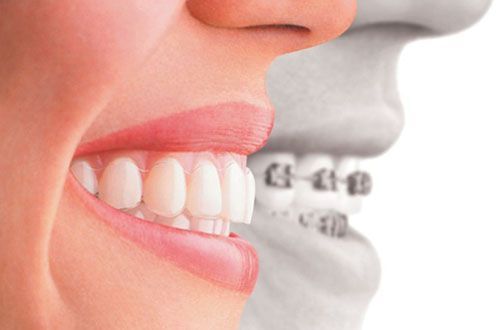 Niềng răng tháo lắp có hiệu quả không? Chuyên gia nha khoa Paris tư vấn
