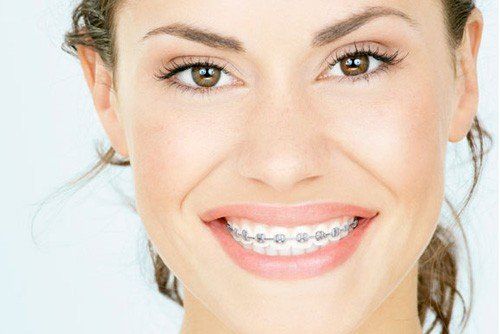 2 cách khắc phục răng hô hiệu quả - Nha khoa Đăng Lưu
