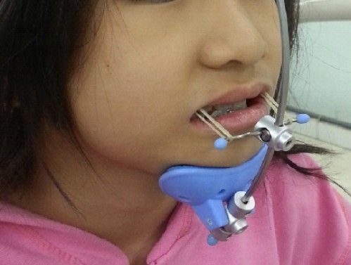 Thời điểm lý tưởng để niềng răng cho trẻ em - Nha khoa Đăng Lưu