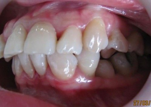 Niềng răng hô điều chỉnh khớp cắn