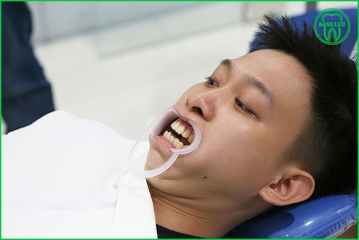 Niềng răng mặt lưỡi tại TP.HCM - Nha khoa Đăng Lưu