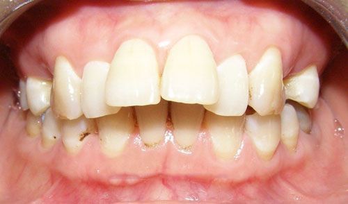 Chữa hô răng hiệu quả tại nha khoa - Nha khoa Đăng Lưu