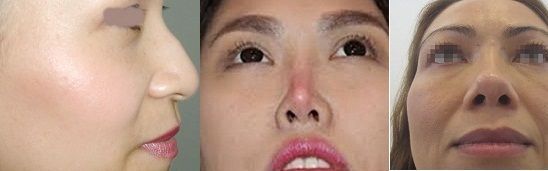 Nâng mũi bọc sụn Kangnam – Mũi đẹp tự nhiên – Kết quả trọn đời - Thẩm mỹ Kangnam