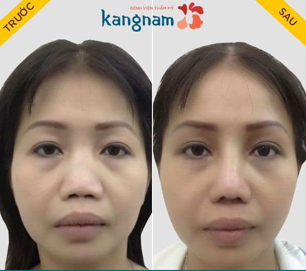 Nâng mũi cấu trúc 4D có gì khác biệt so với công nghệ nâng mũi khác? - Thẩm mỹ Kangnam