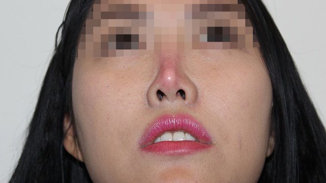 Nâng mũi có bị biến chứng không? – Hỏi đáp cùng chuyên gia - Thẩm mỹ Kangnam