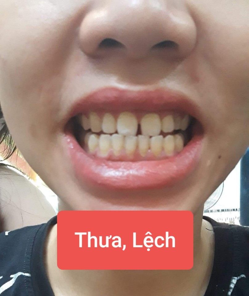 Bọc răng sứ “KHẮC TINH” của răng xấu