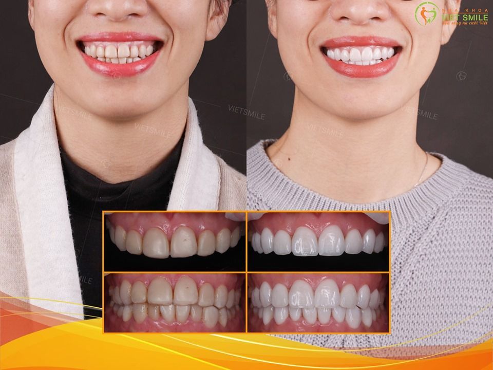 Bạn đã sẵn sàng TỎA SÁNG với hàm răng trắng đẹp chưa?
