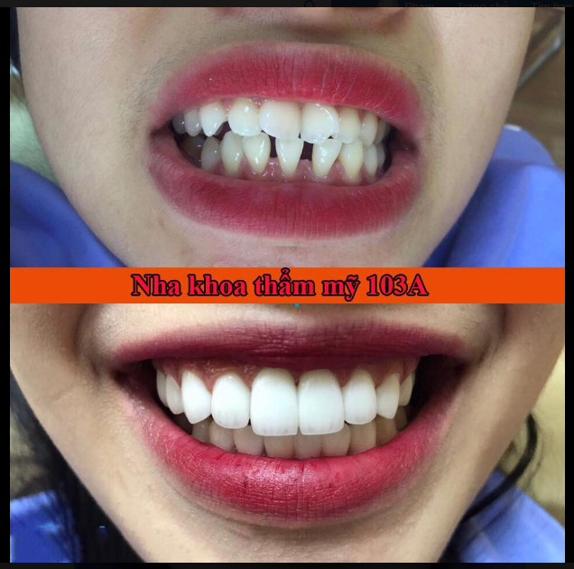 Kết quả sau khi gắn 20 Răng Sứ Thẩm Mỹ cho bệnh nhân răng nhiễm màu, răng thưa, răng lệch hàm