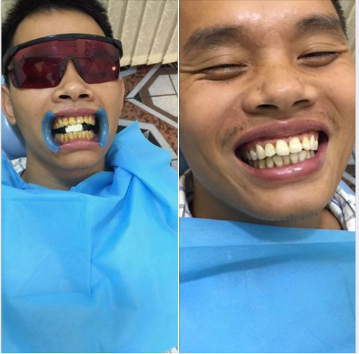Xin post hình ảnh trước và sau của ca tẩy trắng răng sáng nay cho mọi người có động lực ah!