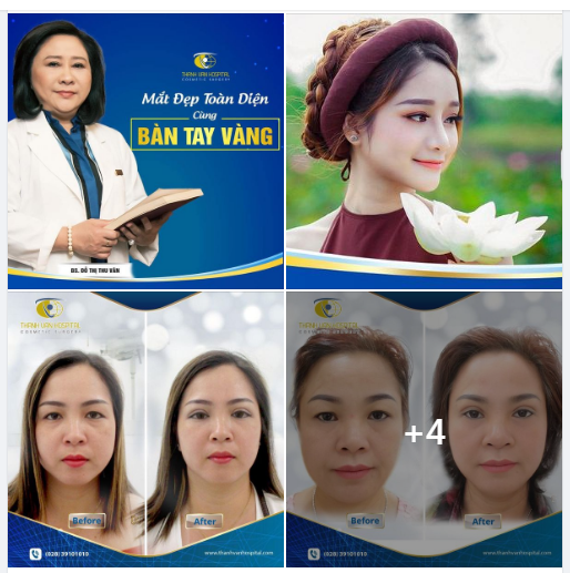 Hầu hết các khách hàng lựa chọn cắt mắt hai mí tại bệnh viện thẩm mỹ Thanh Vân