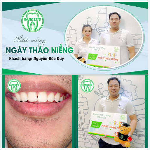 MỪNG NGÀY THÁO NIỀNG Chúc mừng bạn Nguyễn Đức Duy đã Niềng răng thành công tại Nha Khoa Đăng Lưu!