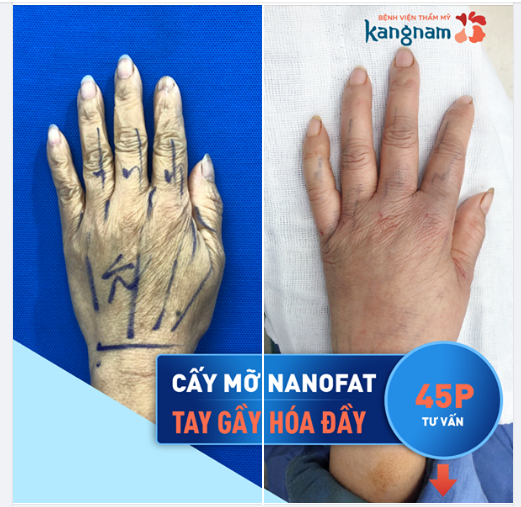 Cấy mỡ Nanofat Trẻ hóa bàn tay