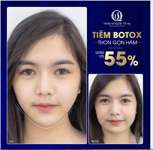Khách hàng trước và sau khi thực hiện tiêm Botox thon gọn hàm của Dr Vũ Quang, khác biệt hoàn toàn phải không ạ ??