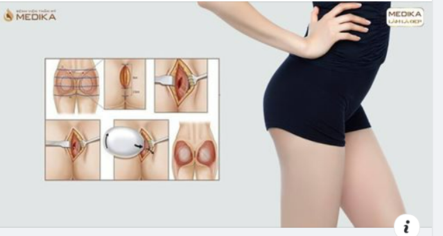 Phẫu thuật nâng mông là một đại phẫu đòi hỏi trình độ chuyên môn cao của bác sĩ thực hiện.