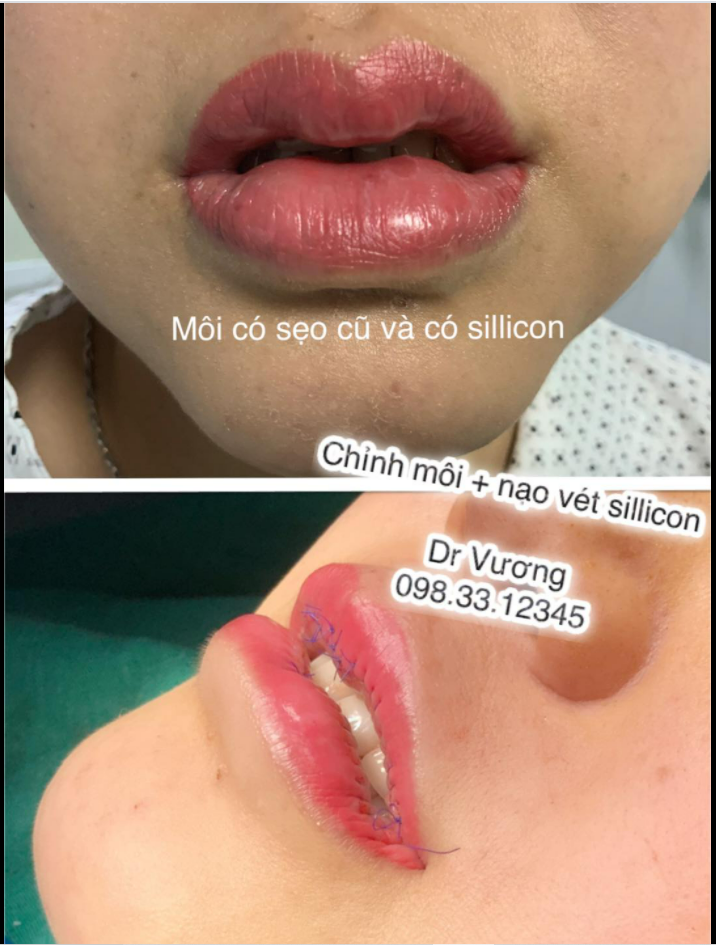 Dr Vương xử lý môi có sẹo cũ và có sillicon bằng phẫu thuật cắt, nạo, vét ... cho bạn gái đến từ Mỹ Đình Thôn, Hà Nội.