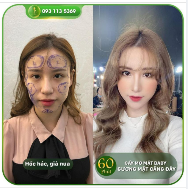 CẤY MỠ MẶT BABY FACE