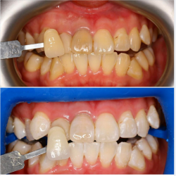 Tẩy trắng răng bằng hệ thống Zoom tại nha khoa Lan Anh chi nhánh Sala, do bác sĩ Trường điều trị
