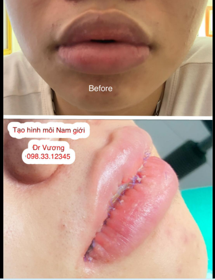 Dr Vương tạo hình môi cho bạn Nam ở Sài Gòn