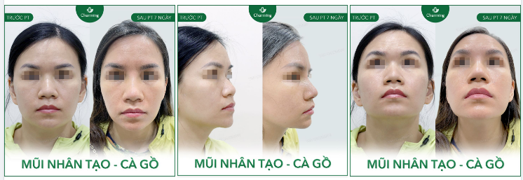 Nếu bạn chưa tin rằng việc nâng mũi có thể giúp bạn cải thiện vẻ bề ngoài khá nhiều thì nàng khách sau đây sẽ là minh chứng rõ ràng cho bạn.
