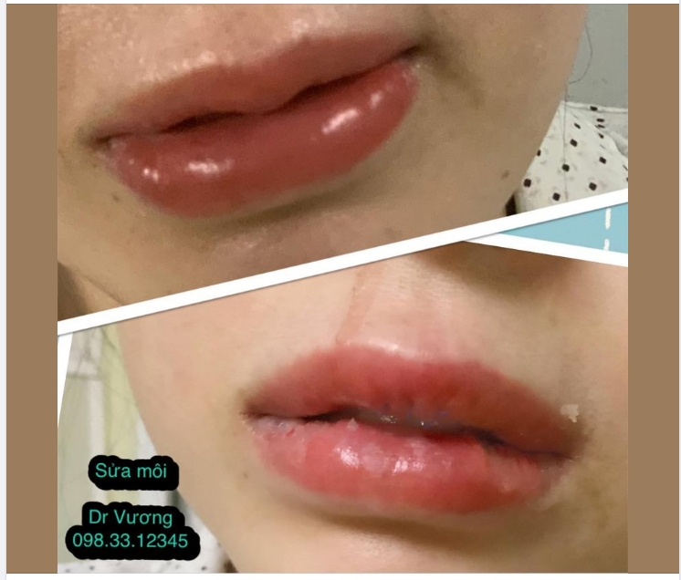 Sửa môi với Dr Vương