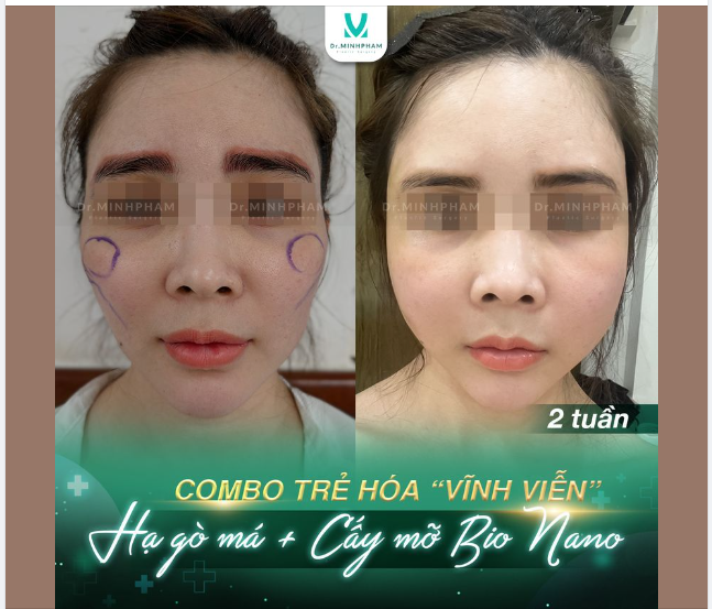 Xinh đẹp hơn, tự tin hơn sau 2 tuần phẫu thuật hạ gò má kết hợp cấy mỡ mặt tại Dr. Minh Phạm.