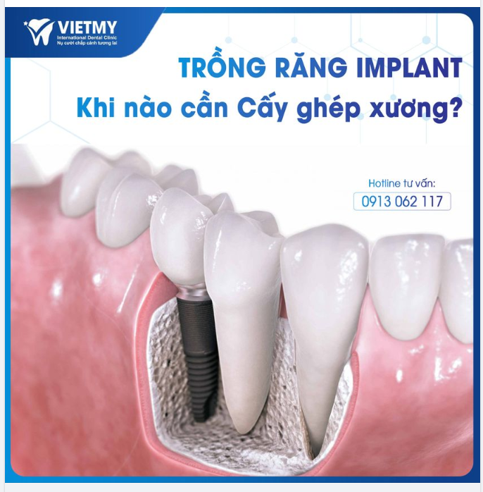 TRỒNG RĂNG IMPLANT KHI NÀO CẦN CẤY GHÉP XƯƠNG